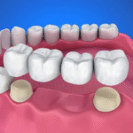 Your Smile with Advanced Crown & Bridges Solutions