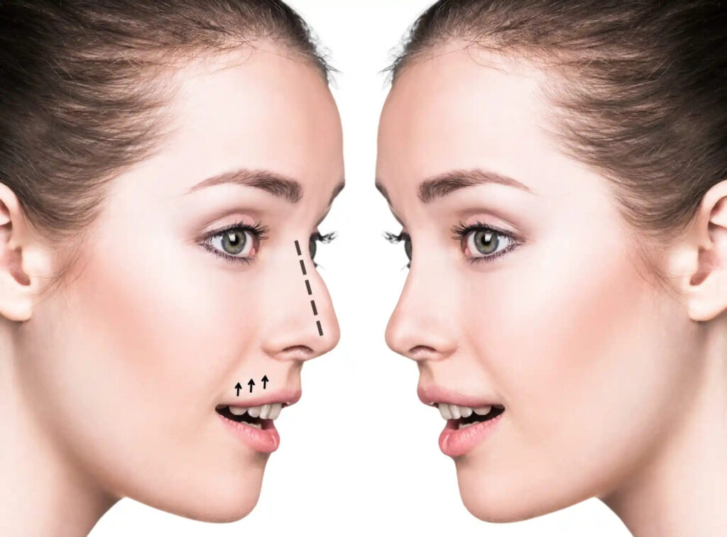 Nose Surgery in Dubai For Balanced Facial Proportions