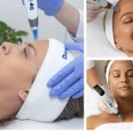 What to Expect from Professional Acne Scar Repair Treatments