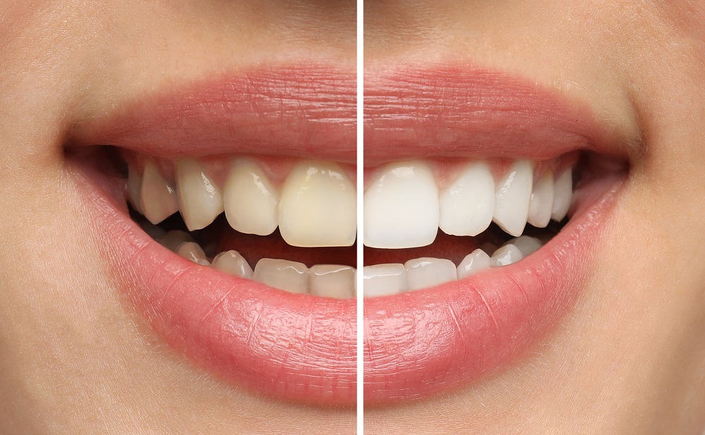 Spots on Your Teeth: How to Identify Cavities vs Stains and Protect Your Smile