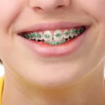 Why Early Braces Can Shape a Child’s Smile for Life