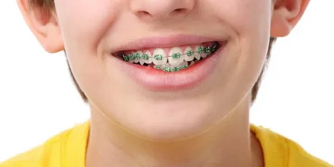 Why Early Braces Can Shape a Child’s Smile for Life