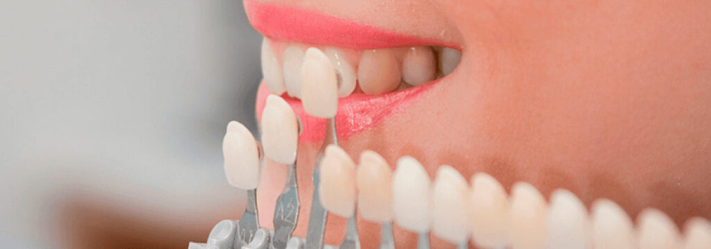 The Truth About Dental Veneers: Cost, Benefits, and What to Expect