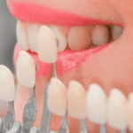 The Truth About Dental Veneers: Cost, Benefits, and What to Expect