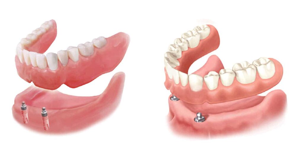 Overdenture Treatment: Cost, Procedure, and Recovery