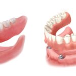 Overdenture Treatment: Cost, Procedure, and Recovery