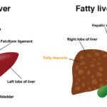 Alpha-Fetoprotein (AFP): What It Means for Your Liver Health