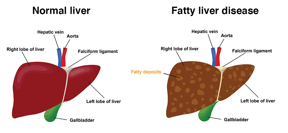 Alpha-Fetoprotein (AFP): What It Means for Your Liver Health