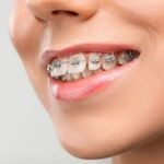 Braces Treatment in Badlapur: A Complete Guide to Getting the Best Braces Treatment