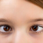Squint Eye Treatment: Non-Surgical vs Surgical Options