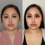 Best Buccal fat removal Surgeon in Dubai Book Now