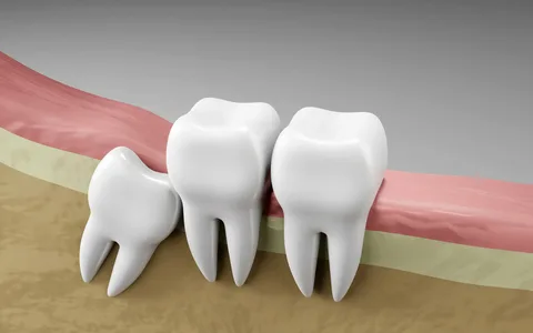 Pain-Free Wisdom Tooth Removal: Modern Approaches for Faster Healing