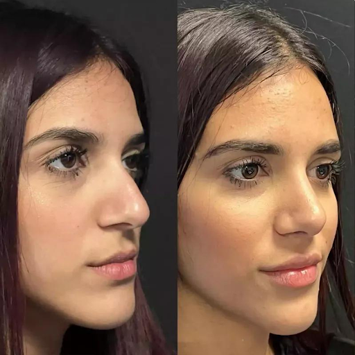 Best Rhinoplasty Surgeon in Dubai Offering World-Class Care