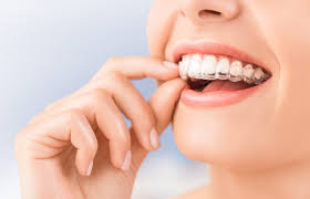 Invisalign Aligners in Ghatkopar: A Clear Path to a Confident Smile