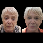 Minimalist Approaches to Jawline Fillers by the Best Plastic Surgeons in Dubai