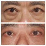 Eye bag removal in Dubai: Scar management tips