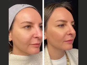 Best Plastic Surgeon in dubai for Mesotherapy Long-Lasting Results