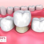 Tooth Colored Filling in Solapur for Natural-Looking Teeth