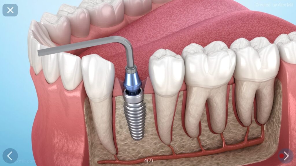 Saving Natural Teeth in the Age of Advanced Dentistry