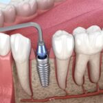 Saving Natural Teeth in the Age of Advanced Dentistry