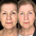 Expert-Led Profhilo Treatment in Dubai Explained