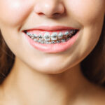 How Braces Treatment in Sambalpur Helps Achieve a Healthier, Straighter Smile
