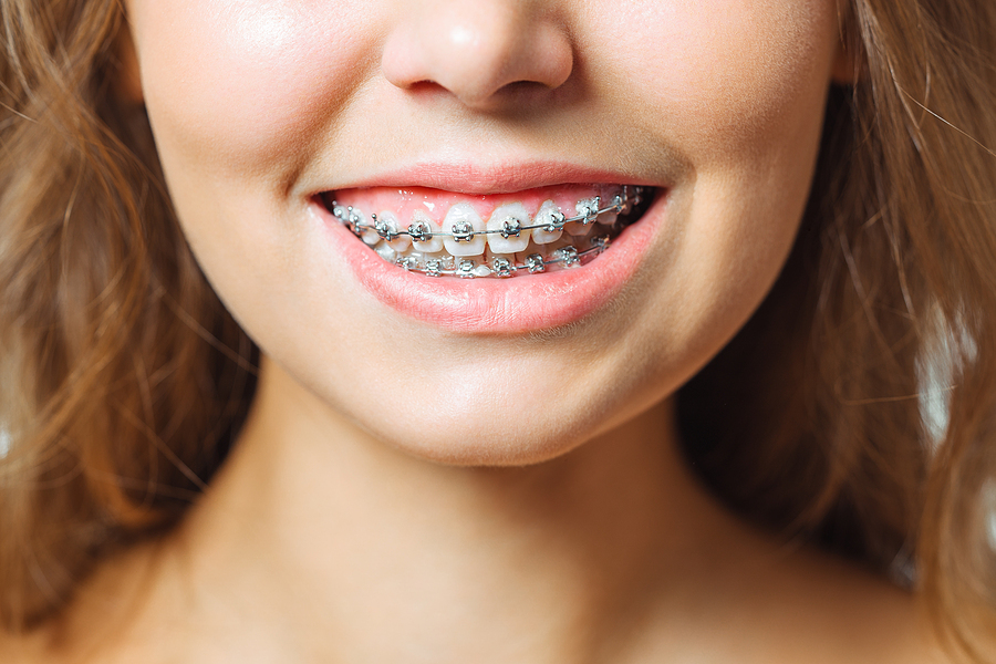 How Braces Treatment in Sambalpur Helps Achieve a Healthier, Straighter Smile