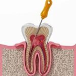 What Is Single Sitting Root Canal Treatment and How Is Painless Root Canal Treatment in Badlapur Done?