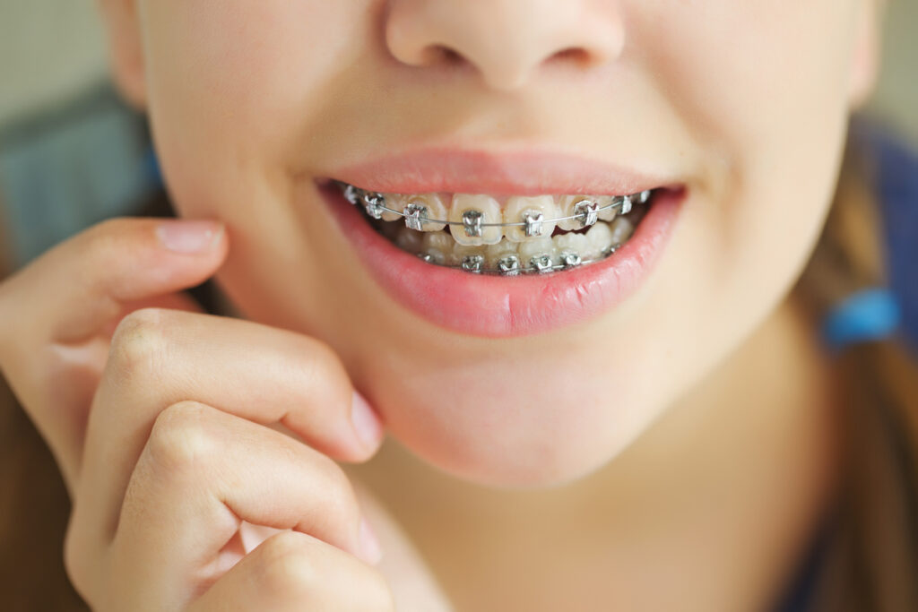 Beyond the Metal: Your Journey with a Braces Treatment Specialist in Pune