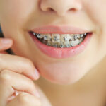 Beyond the Metal: Your Journey with a Braces Treatment Specialist in Pune