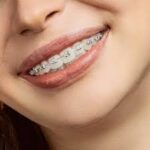 Clear Aligners vs Ceramic Braces: Which Orthodontic Treatment Is Right for You?