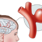 Understanding Your Options for Brain Aneurysm Treatment in Saket
