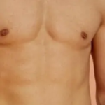 شفط الدهون في جدة للحصول على قوام أكثر رشاقة