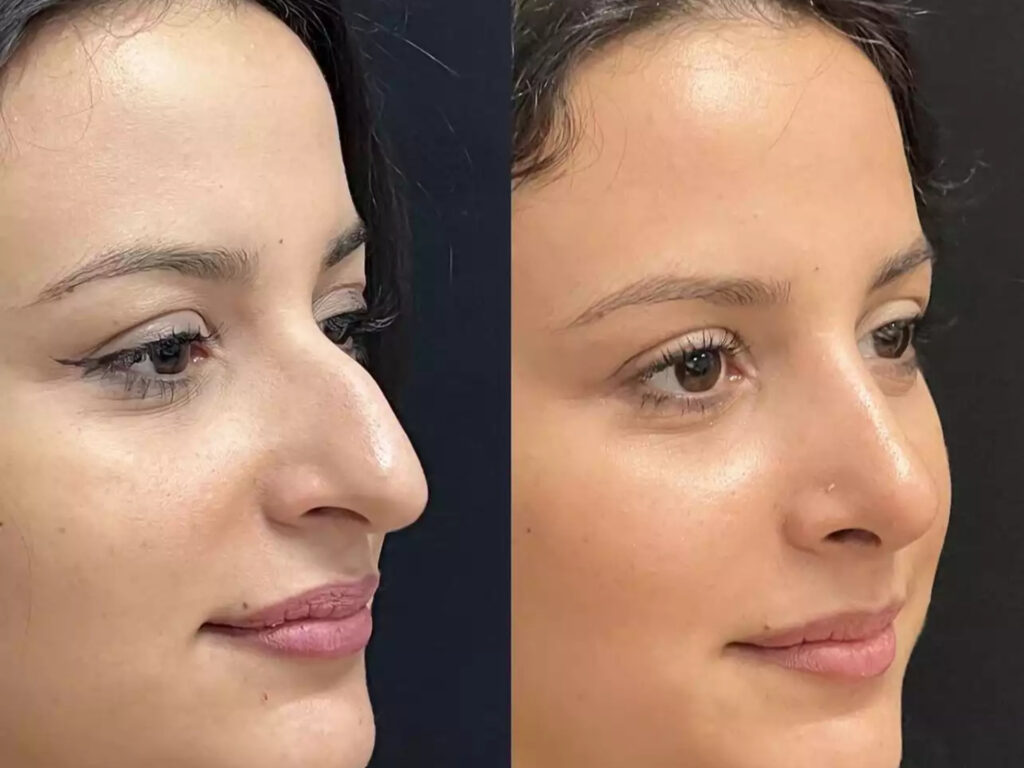 Rhinoplasty in Dubai: Evidence-Based Nose Surgery Explained