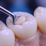 Understanding the Benefits of Tooth colored filling in Bhandara for Natural Smiles