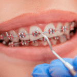 Braces Treatment for a Perfect Smile: What You Should Know Before Starting