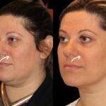 Can Sculptra Be Reversed? Best Plastic Surgeons in Dubai Clarify