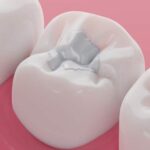 Tooth Colored Filling vs Silver Filling: Which Is Better?