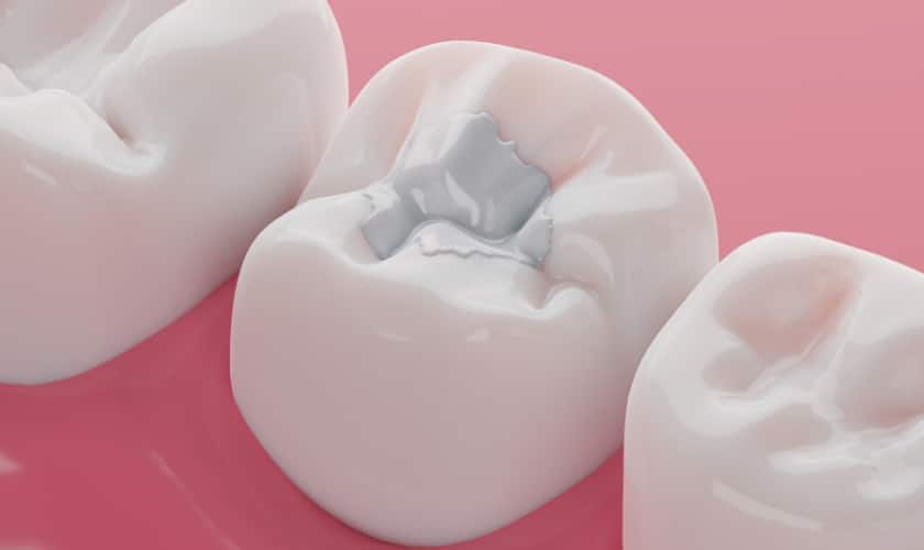 Tooth Colored Filling vs Silver Filling: Which Is Better?