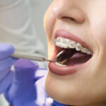 Braces Treatment in Your 30s and 40s: Is It Worth It?