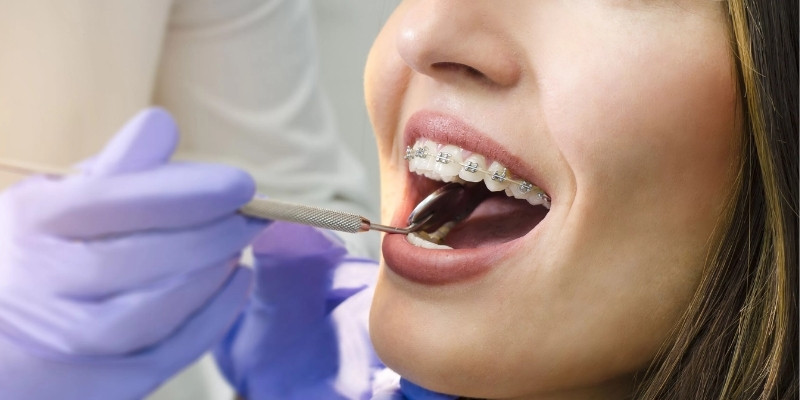 Braces Treatment in Your 30s and 40s: Is It Worth It?