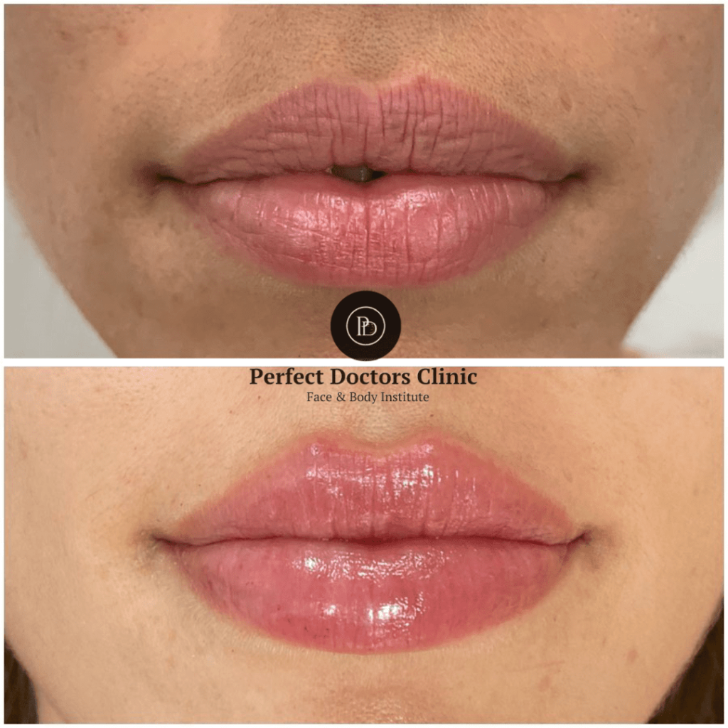 Lip Shape Customization with Juvederm by the Best Plastic Surgeon in dubai