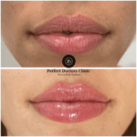 Lip Shape Customization with Juvederm by the Best Plastic Surgeon in dubai