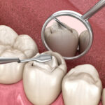 How Tooth-Colored Fillings Improve Your Smile
