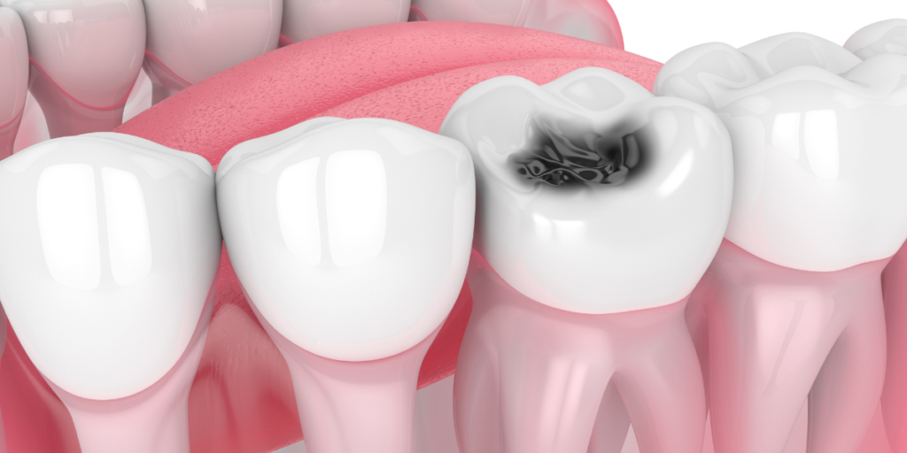 Modern Approaches to Treating Tooth Decay Without Compromising Your Smile