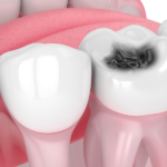 Modern Approaches to Treating Tooth Decay Without Compromising Your Smile