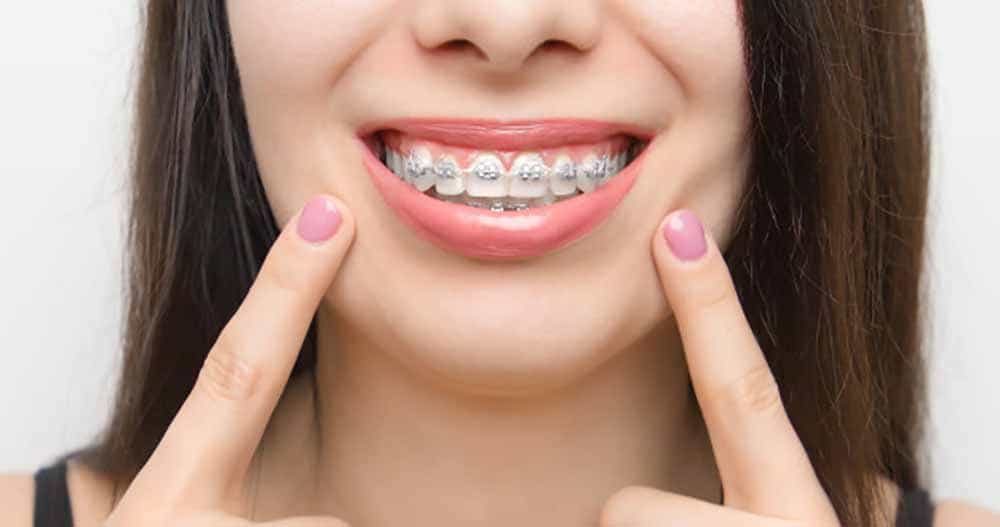 What Changes First During Braces Treatment: Teeth, Bite, or Face Shape?