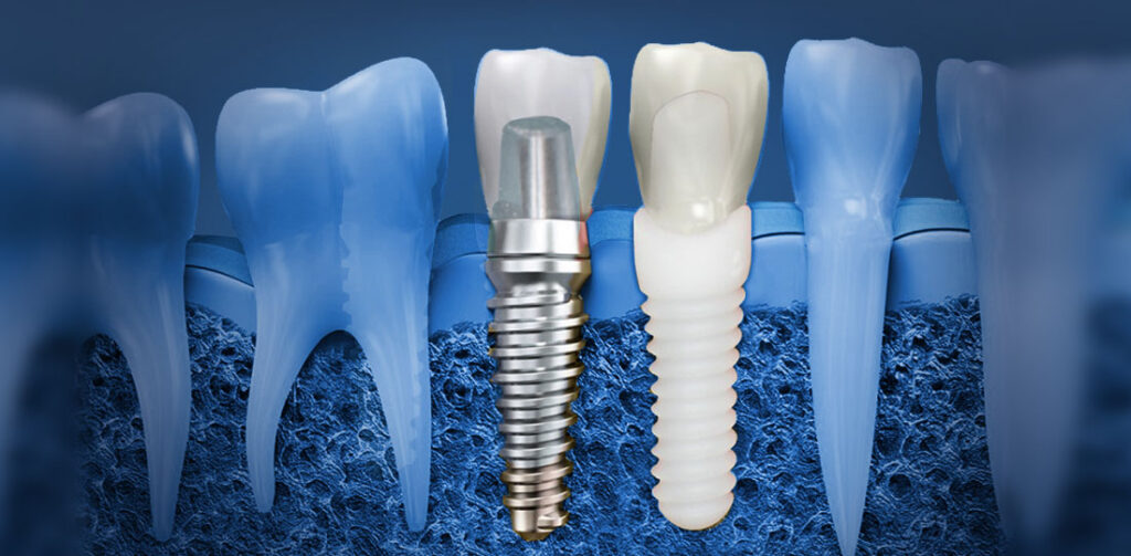 Is Dental Implant Treatment Good for You