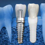 Is Dental Implant Treatment Good for You