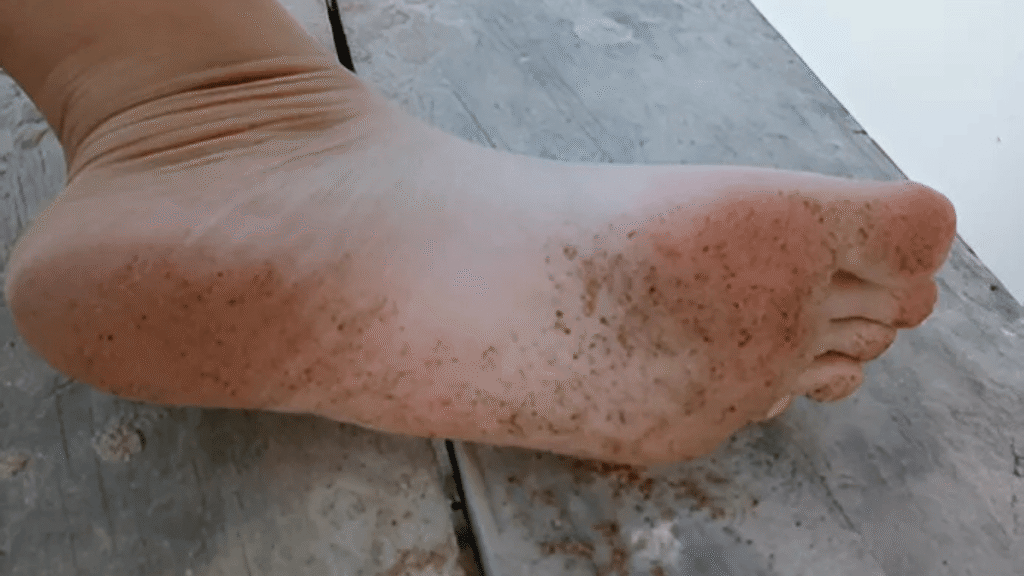 Black-Patches-on-Bottom-of-Feet: Causes and Treatment
